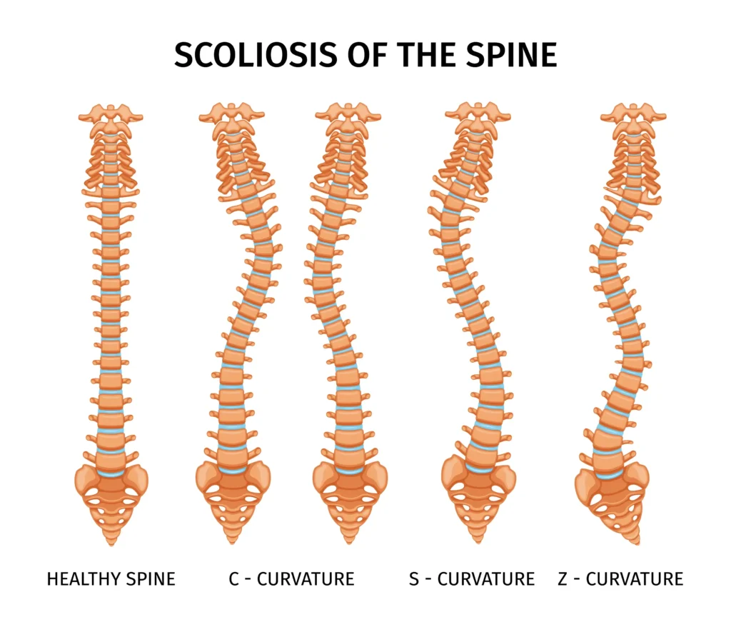 scoliosis chiropractor